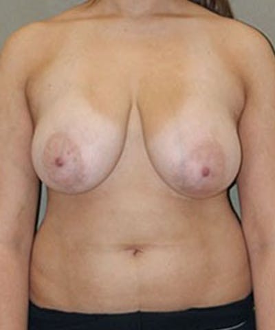 Breast Reduction Before & After Gallery - Patient 357606 - Image 1