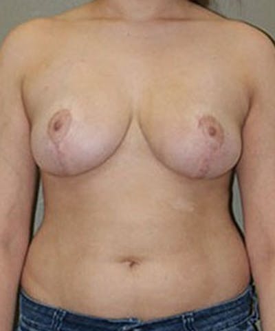 Breast Reduction Before & After Gallery - Patient 357606 - Image 2
