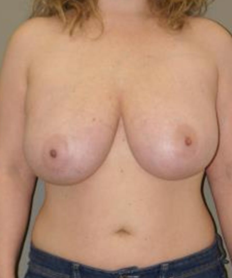 Breast Reduction Before & After Gallery - Patient 378014 - Image 1