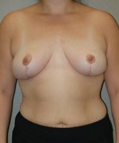 Breast Reduction Before & After Gallery - Patient 594593 - Image 2