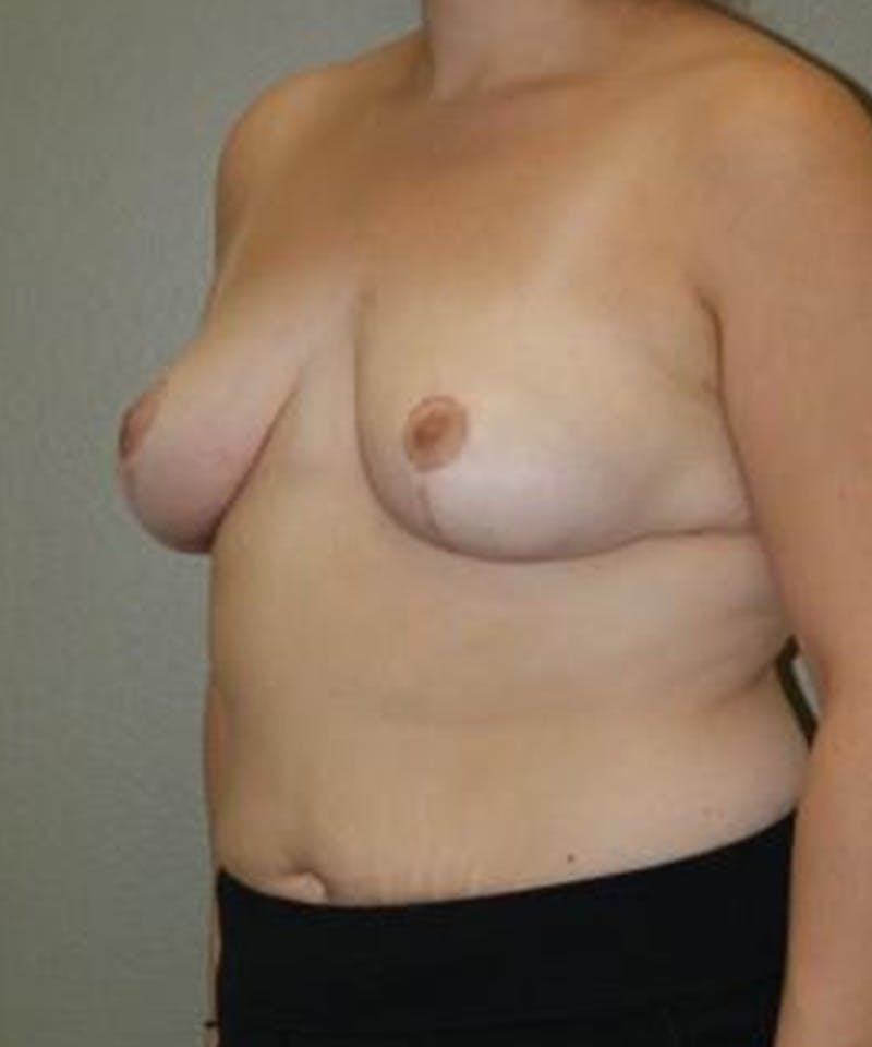 Breast Reduction Before & After Gallery - Patient 594593 - Image 4