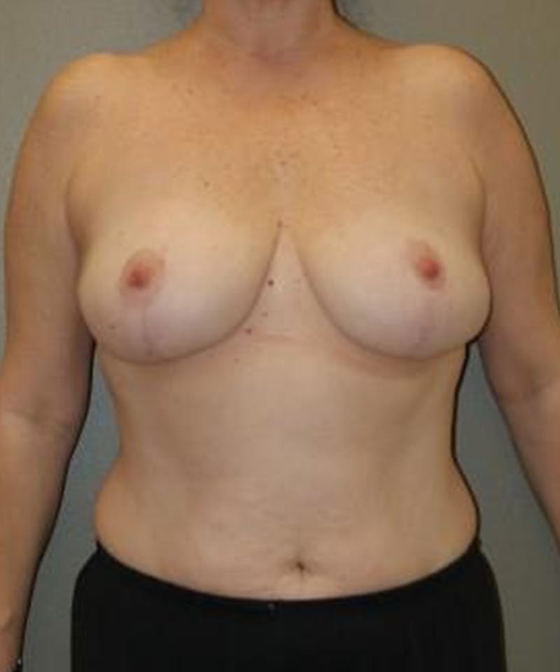 Breast Reduction Before & After Gallery - Patient 821747 - Image 2