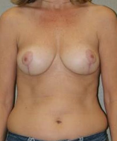 Breast Reduction Before & After Gallery - Patient 409606 - Image 2