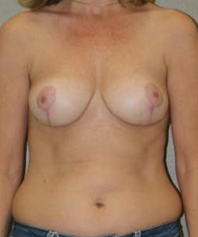 Breast Reduction Before & After Gallery - Patient 409606 - Image 2