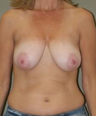 Breast Reduction Before & After Gallery - Patient 409606 - Image 1