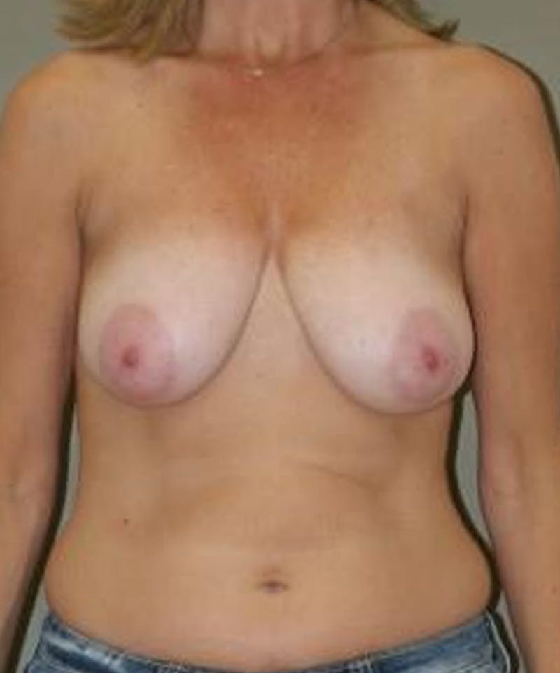 Breast Reduction Before & After Gallery - Patient 409606 - Image 1