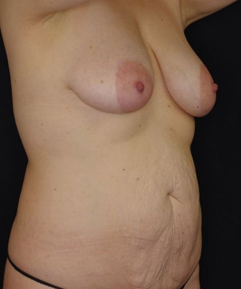 Breast Lift Before & After Gallery - Patient 286050 - Image 3