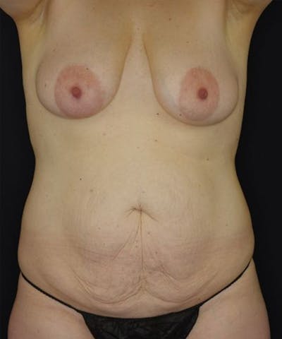 Breast Lift Before & After Gallery - Patient 286050 - Image 1