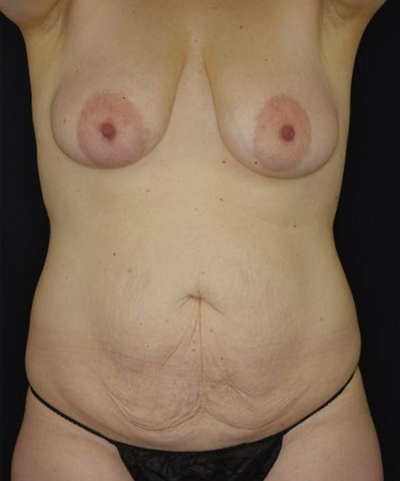 Breast Lift Before & After Gallery - Patient 286050 - Image 1