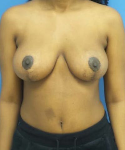 Breast Lift Before & After Gallery - Patient 894995 - Image 2