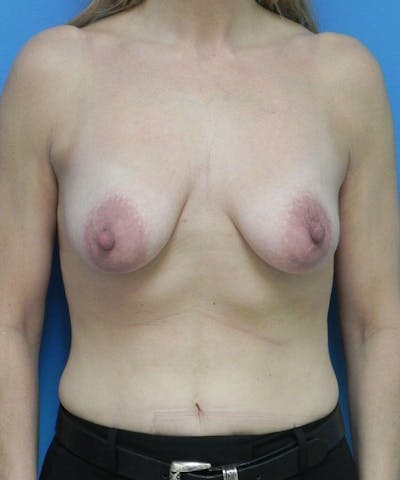 Breast Lift Before & After Gallery - Patient 974240 - Image 1