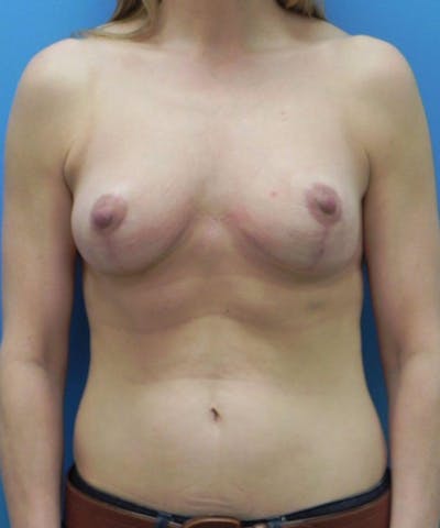 Breast Lift Before & After Gallery - Patient 974240 - Image 2
