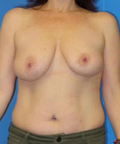 Breast Lift Before & After Gallery - Patient 304656 - Image 1