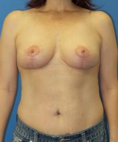 Breast Lift Before & After Gallery - Patient 304656 - Image 2