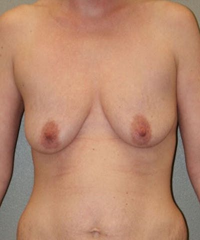Breast Lift Before & After Gallery - Patient 113737 - Image 1
