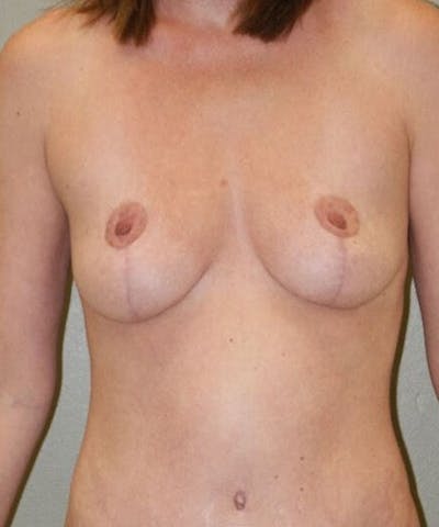 Breast Lift Before & After Gallery - Patient 113737 - Image 2
