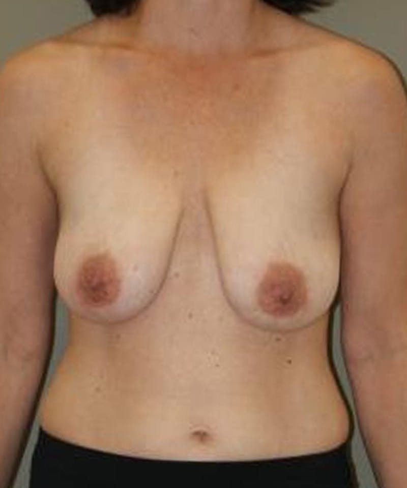 Breast Lift Before & After Gallery - Patient 371916 - Image 1