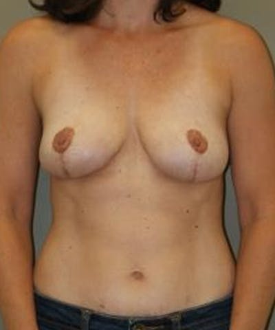 Breast Lift Before & After Gallery - Patient 371916 - Image 2