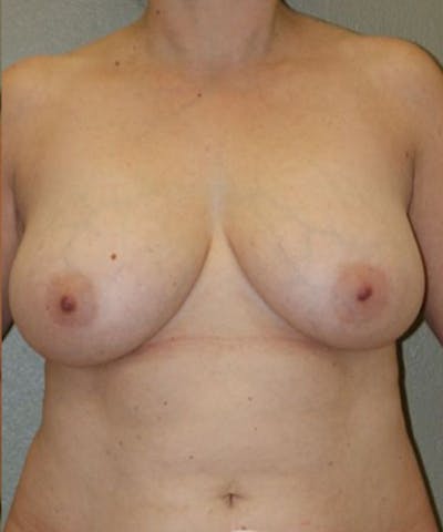 Breast Lift Before & After Gallery - Patient 269483 - Image 1