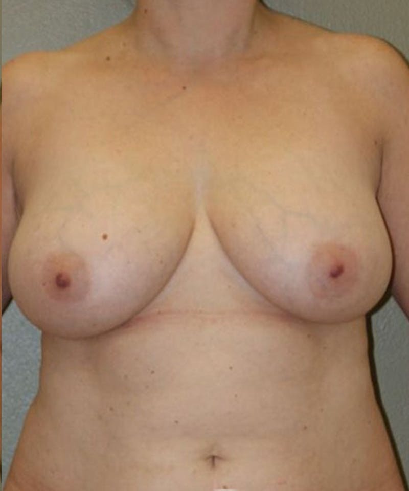 Breast Lift Before & After Gallery - Patient 269483 - Image 1