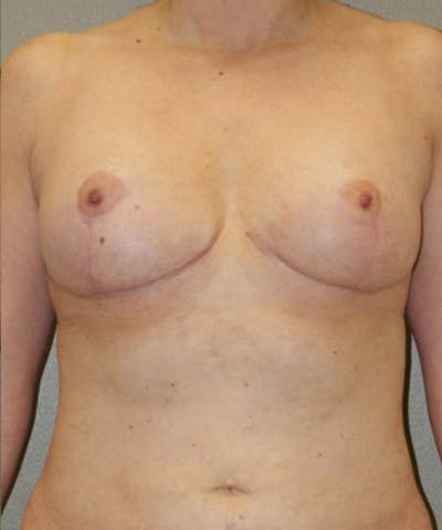 Breast Lift Before & After Gallery - Patient 269483 - Image 2