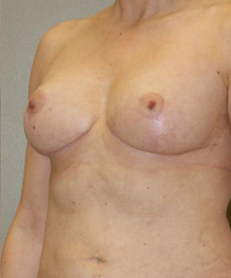 Breast Lift Before & After Gallery - Patient 269483 - Image 4