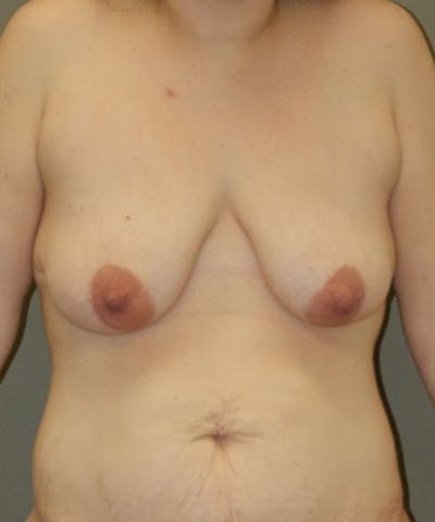 Breast Lift Before & After Gallery - Patient 418464 - Image 1