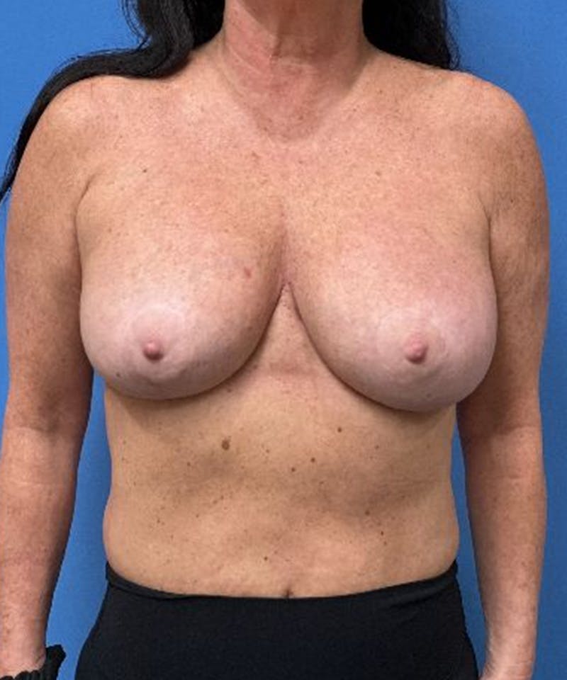 Breast Augmentation Before & After Gallery - Patient 400684 - Image 2