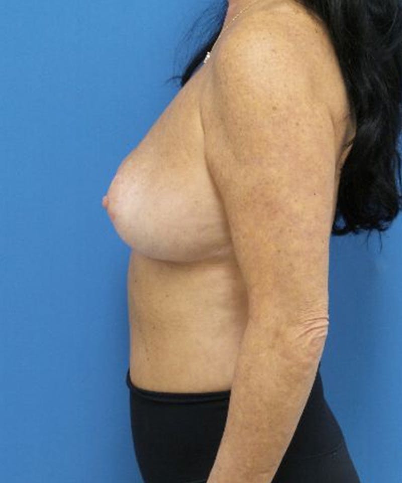 Breast Augmentation Before & After Gallery - Patient 400684 - Image 5