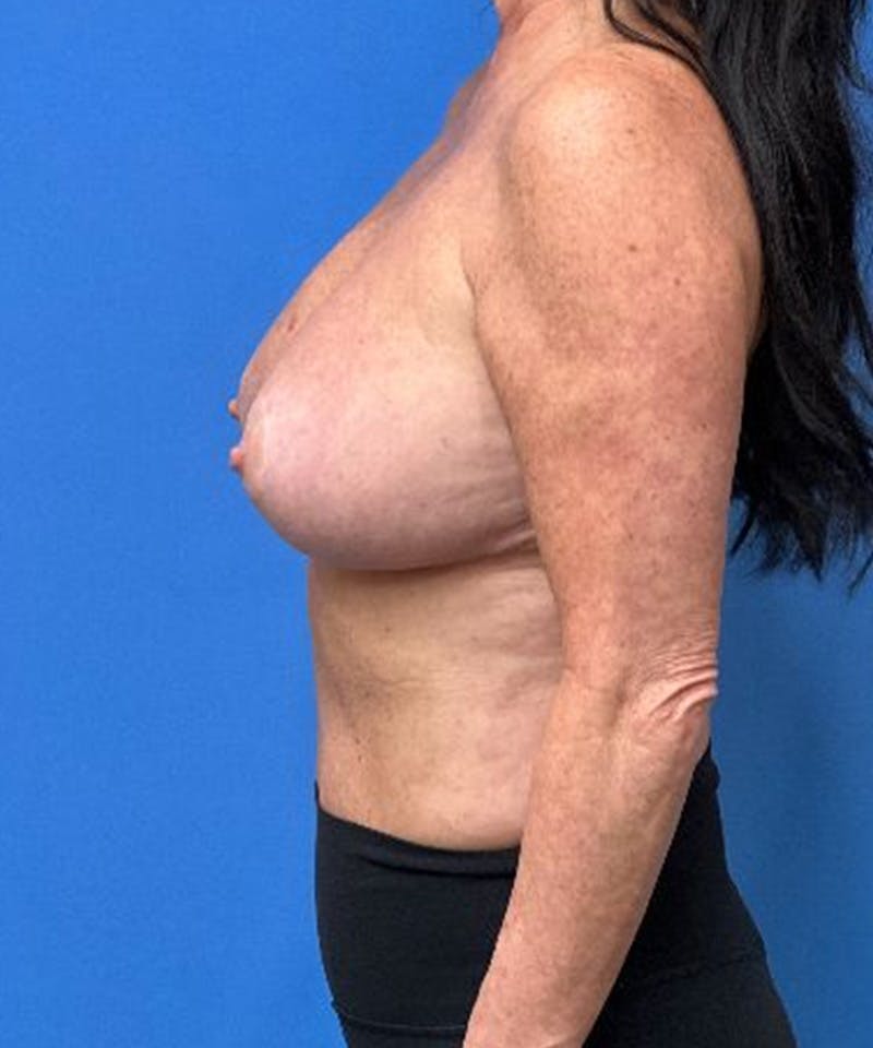 Breast Augmentation Before & After Gallery - Patient 400684 - Image 6