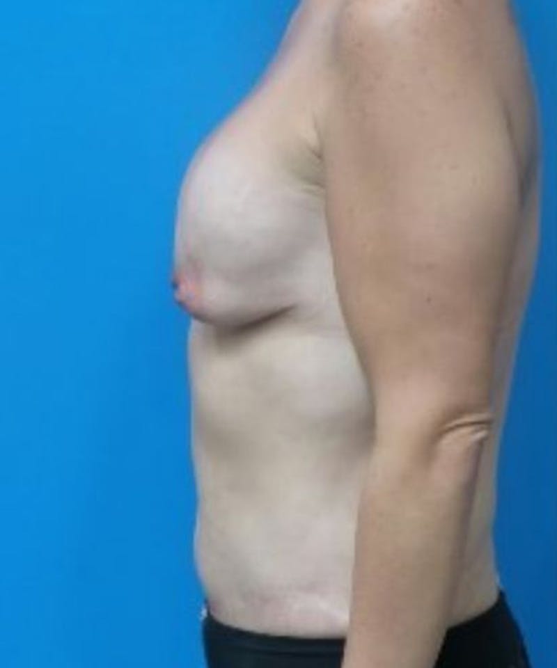 Breast Augmentation Before & After Gallery - Patient 810733 - Image 3