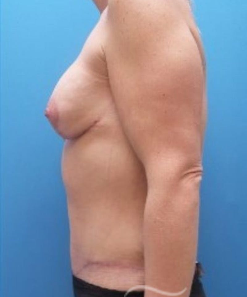 Breast Augmentation Before & After Gallery - Patient 810733 - Image 4