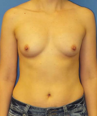 Breast Augmentation Before & After Gallery - Patient 245379 - Image 1