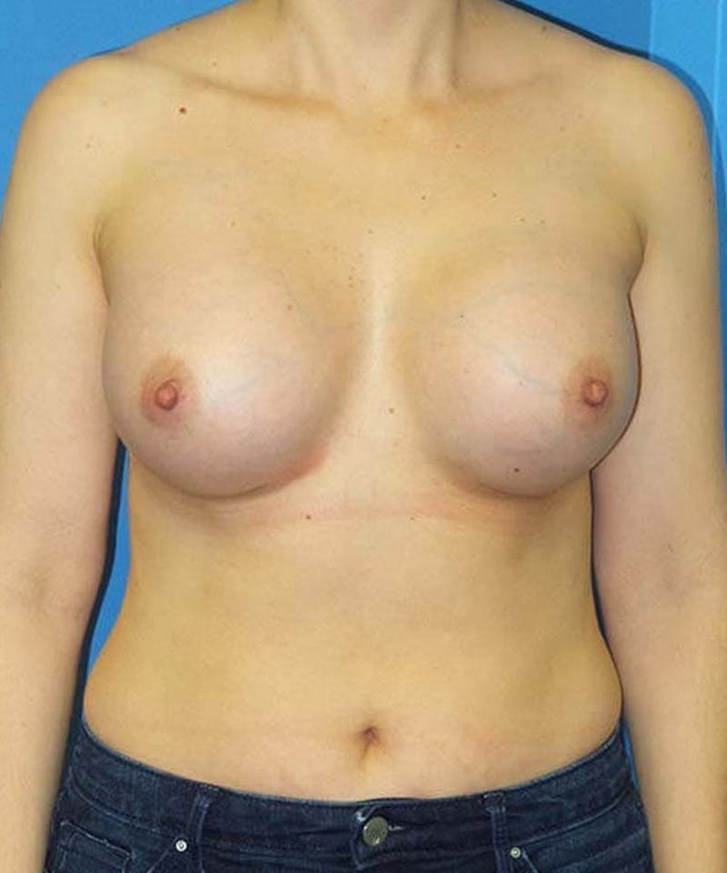 Breast Augmentation Before & After Gallery - Patient 245379 - Image 2