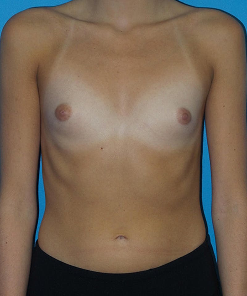 Breast Augmentation Before & After Gallery - Patient 304276 - Image 1