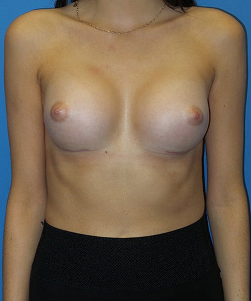 Breast Augmentation Before & After Gallery - Patient 304276 - Image 2