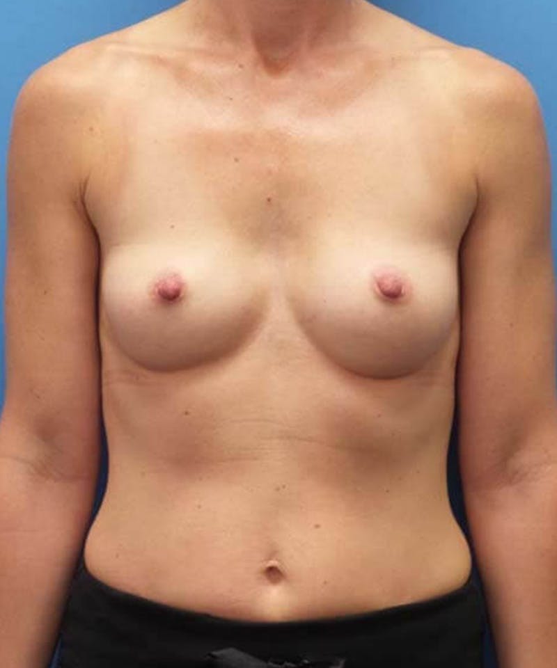 Breast Augmentation Before & After Gallery - Patient 266685 - Image 1