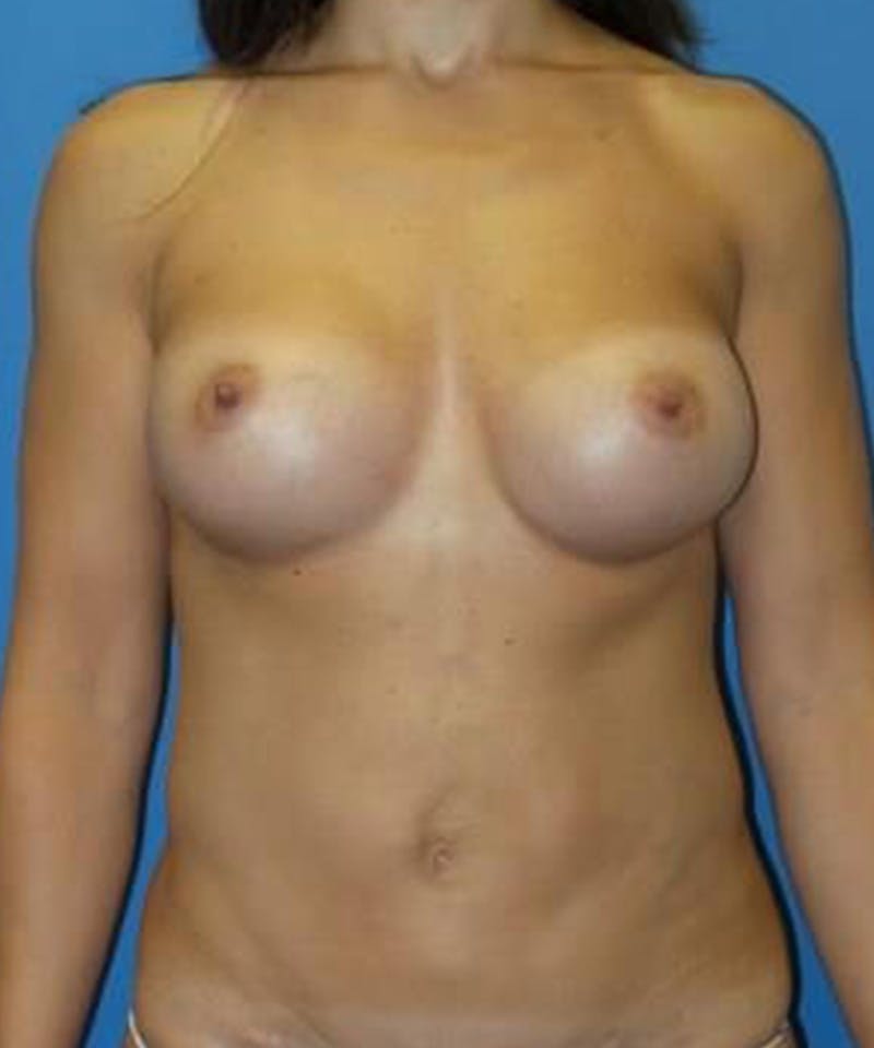 Breast Augmentation Before & After Gallery - Patient 106714 - Image 2