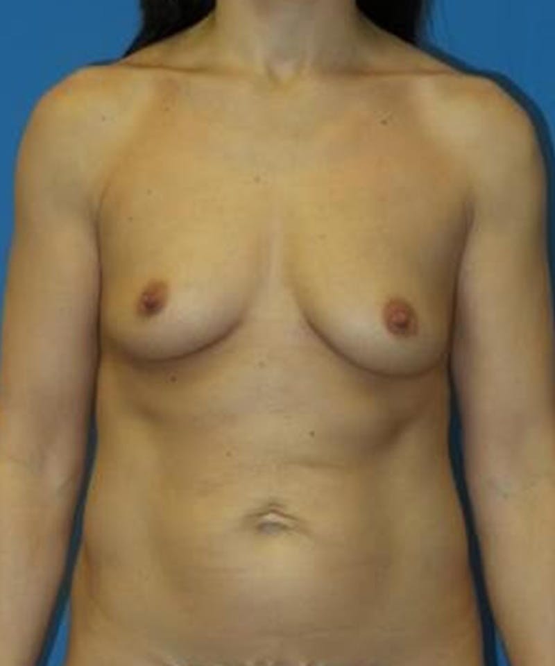 Breast Augmentation Before & After Gallery - Patient 106714 - Image 1
