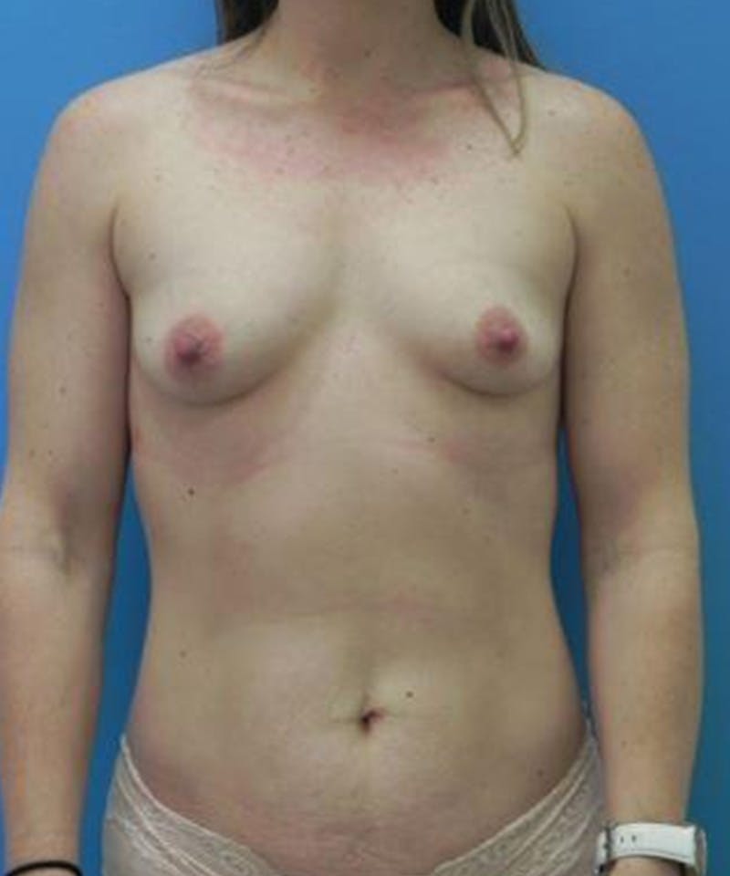 Breast Augmentation Before & After Gallery - Patient 129073 - Image 1