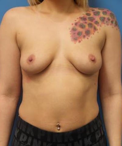 Breast Augmentation Before & After Gallery - Patient 373082 - Image 1