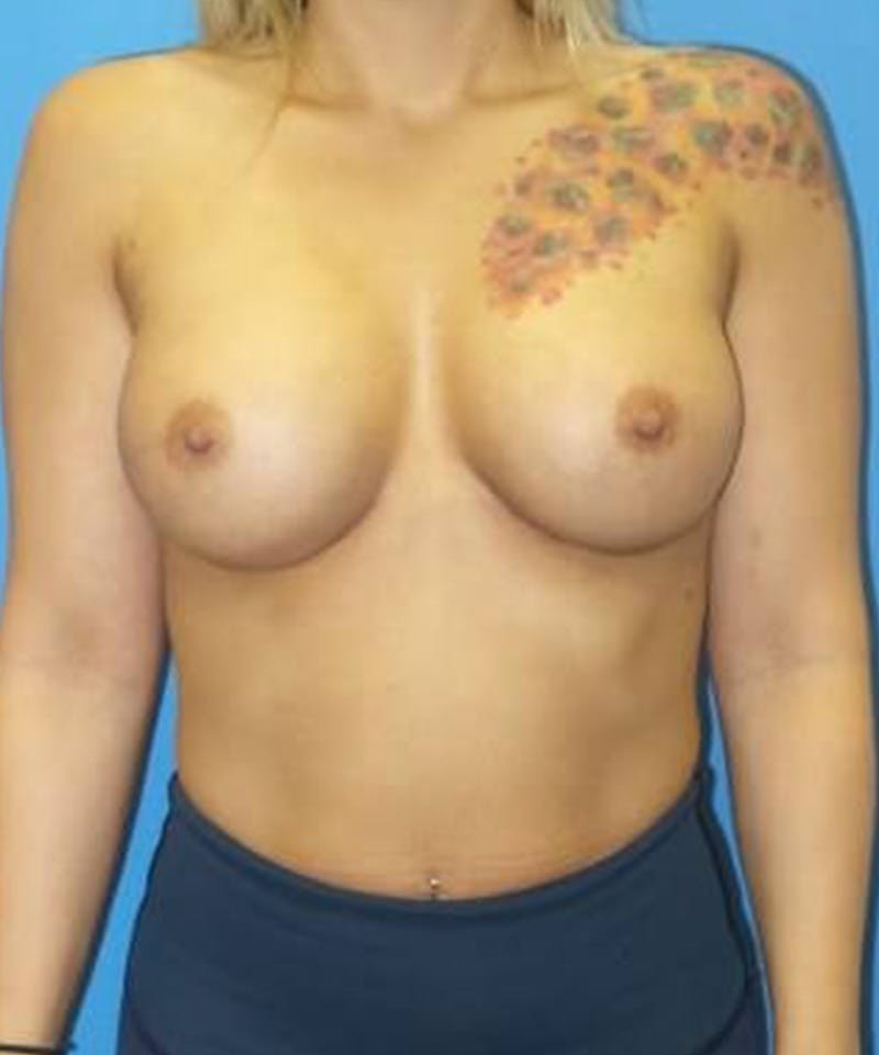 Breast Augmentation Before & After Gallery - Patient 373082 - Image 2