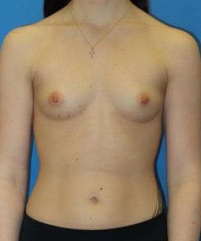Breast Augmentation Before & After Gallery - Patient 229283 - Image 1