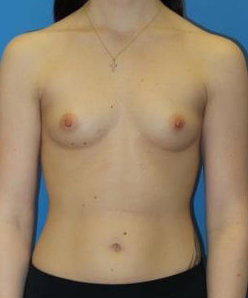 Breast Augmentation Before & After Gallery - Patient 229283 - Image 1