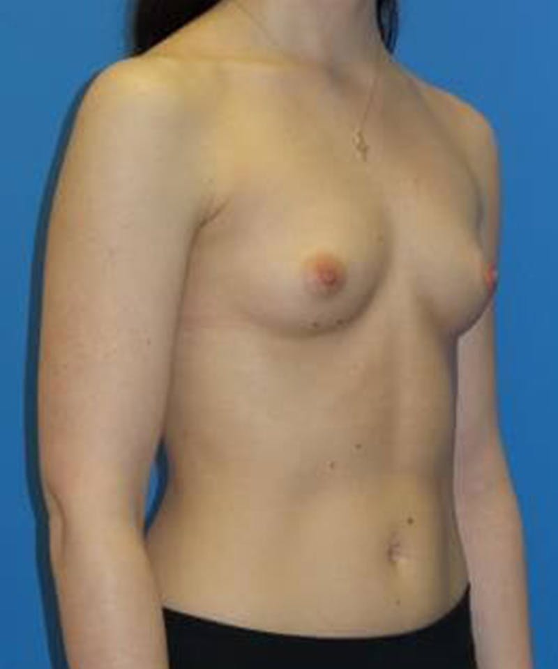 Breast Augmentation Before & After Gallery - Patient 229283 - Image 3
