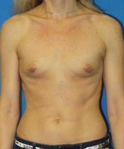 Breast Augmentation Before & After Gallery - Patient 172418 - Image 1