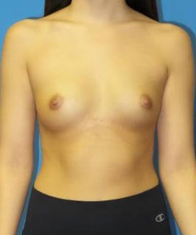 Breast Augmentation Before & After Gallery - Patient 136785 - Image 1