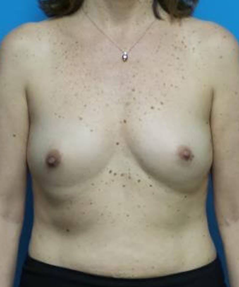 Breast Augmentation Before & After Gallery - Patient 349856 - Image 1
