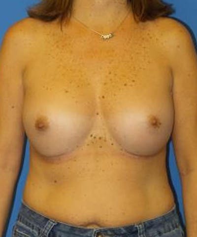 Breast Augmentation Before & After Gallery - Patient 349856 - Image 2