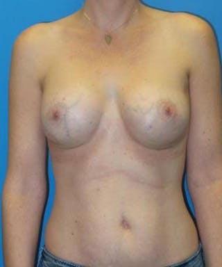 Breast Augmentation Before & After Gallery - Patient 117080 - Image 2